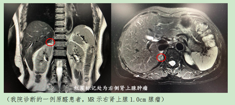 元凶可能就是肾上腺长的一颗"小黄豆"