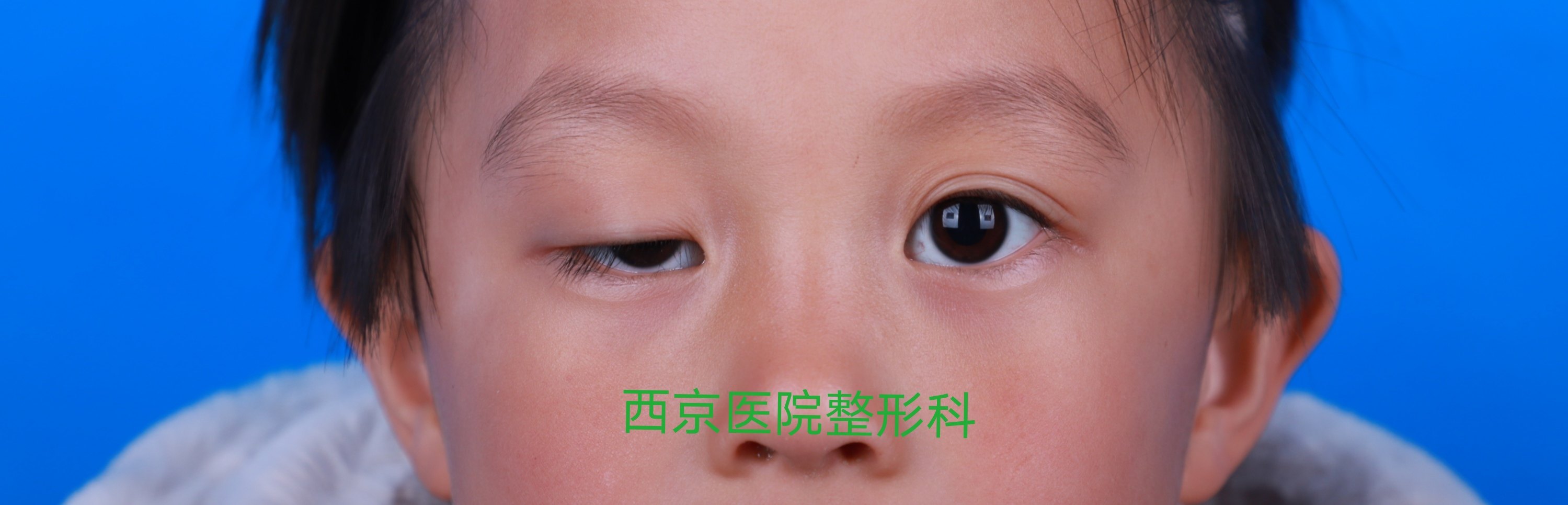 儿童中重度上睑下垂的手术治疗