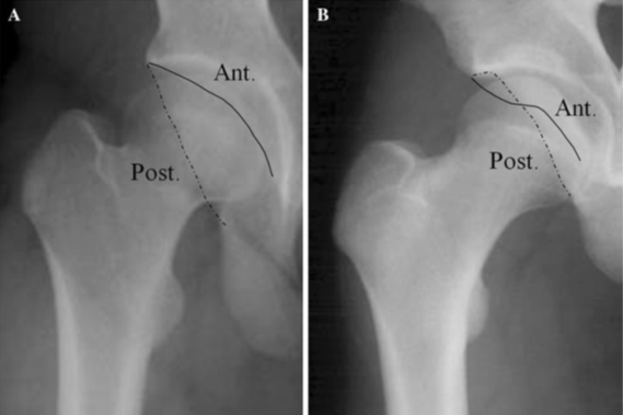 perthes病:legg-calvé-perthes病后的患病和未患病髋