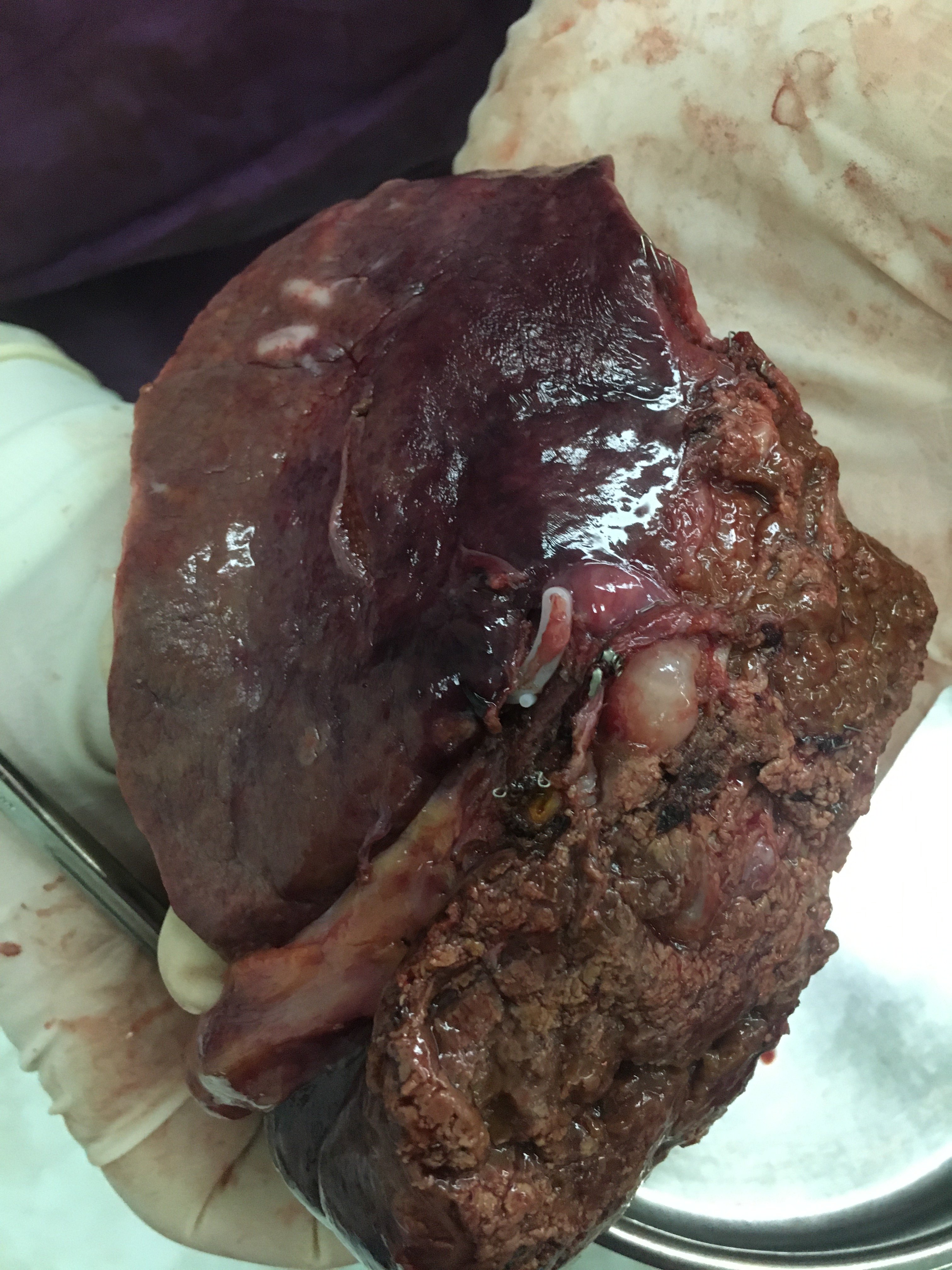 左门静脉,左胆管游离结扎切断,然后再切除左半肝,保证肿瘤的切除的