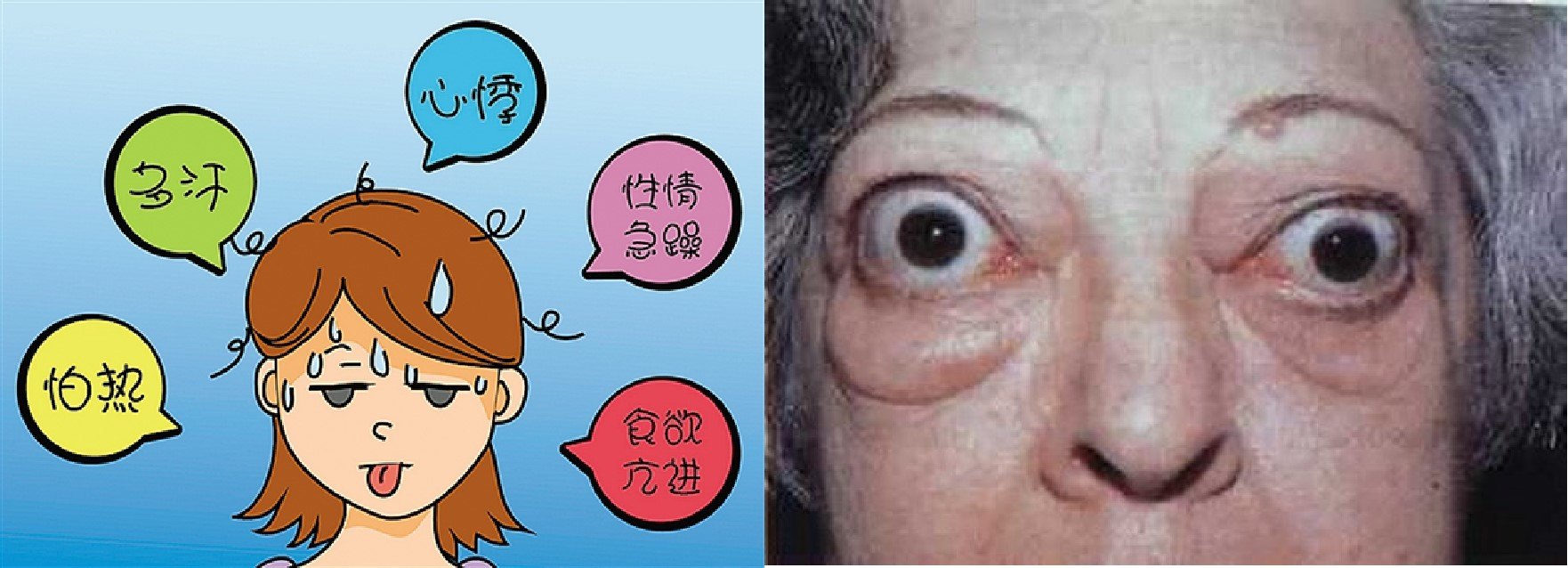 6.体征:突眼症,甲状腺肿大,胫前黏液性水肿等;5.