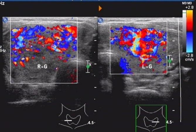 (超声上表现为双侧甲状腺弥漫性肿大,回声增粗减低,血流信号丰富,呈"