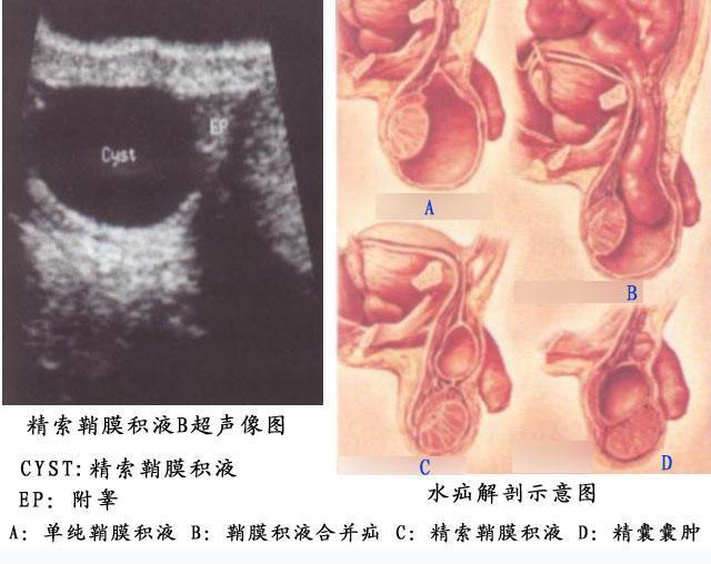 何谓小儿睾丸鞘膜积液