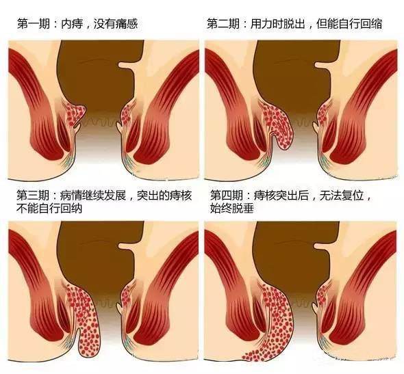 混合痔脱出嵌顿,内痔嵌顿,外痔水肿,肛门疼痛明显者,还有混合痔并发