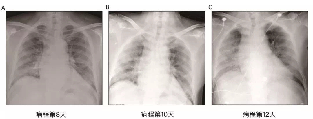 重磅|全世界首例新冠肺炎病理解剖结果[全文翻译]