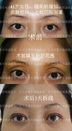 改善上眼睑松弛凹陷的案例和简介(切开法双眼皮 上眼睑凹陷脂肪填充)