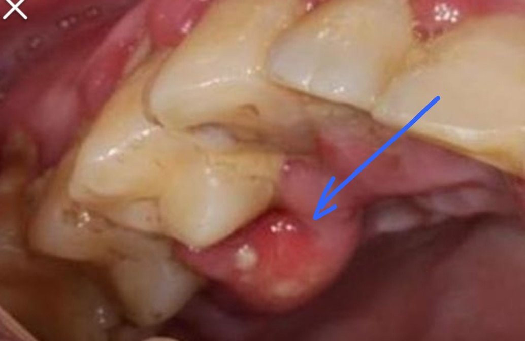 牙齿咬合面近远中向可见一裂痕,轻微咬合痛,局部牙龈一红肿包块,触之