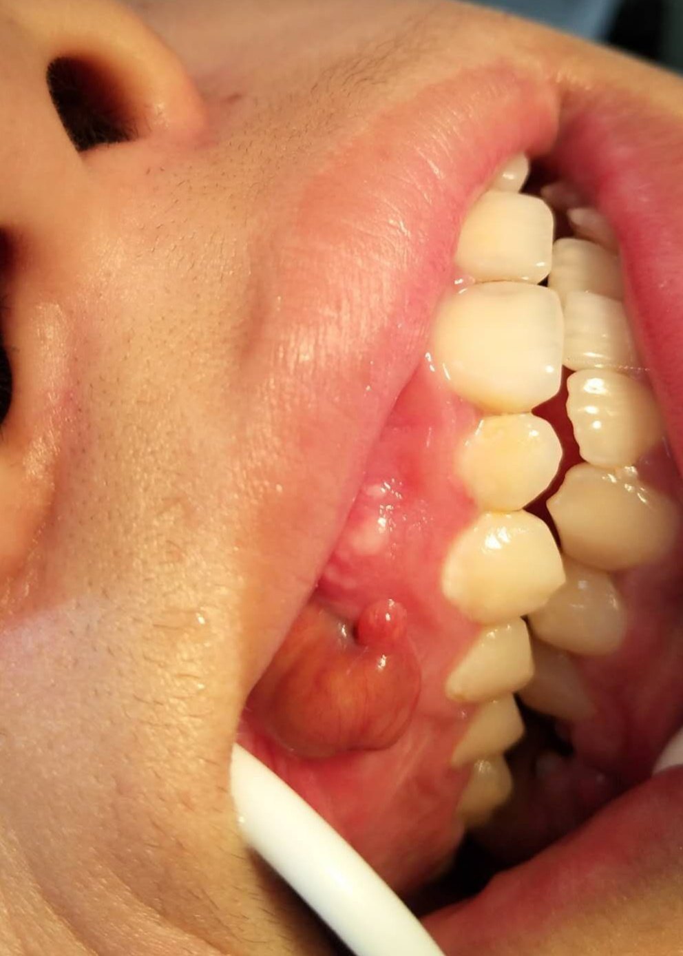 如上图:右上第1双尖牙的牙龈上方可见一个红肿的包块,摸起来比较软,轻