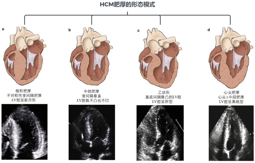 仅切除瓣下肌肉并不能完全解决问题,于是便有了改良morrow扩大术.