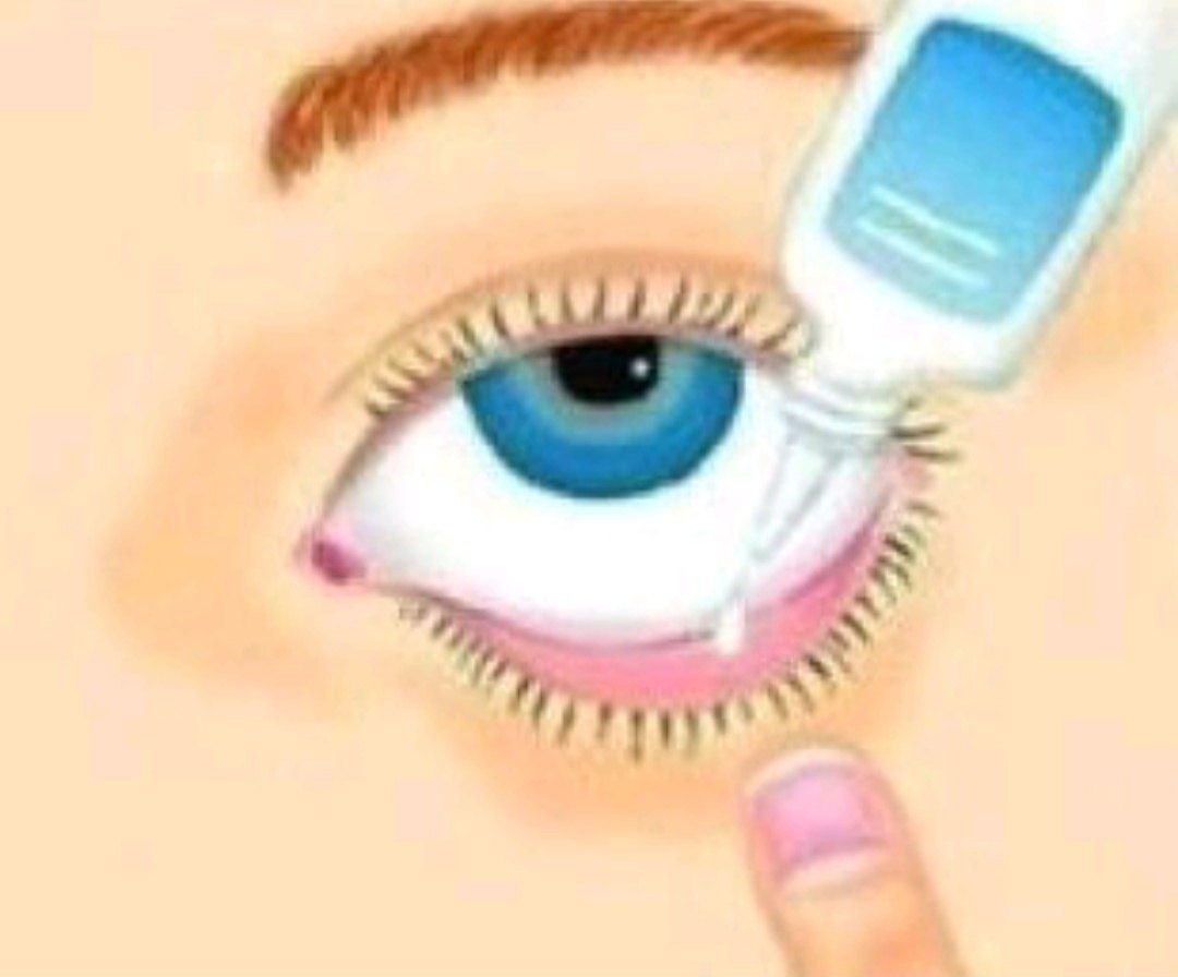 滴眼后用手按压泪囊部5到8分钟(两侧内眼角部位),以免药液流入鼻腔