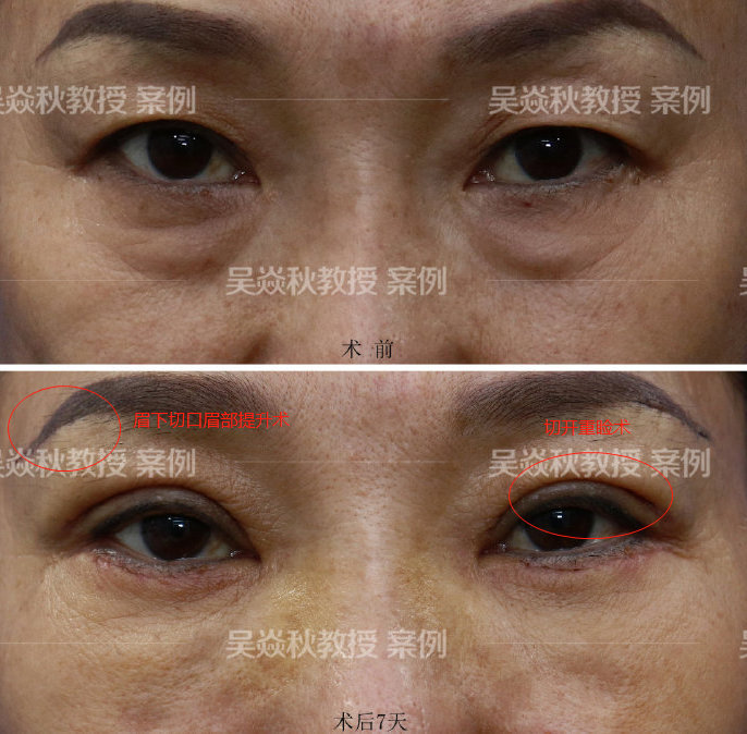 眼皮松弛下垂,是做双眼皮还是提眉好?吴焱秋教授为您解答