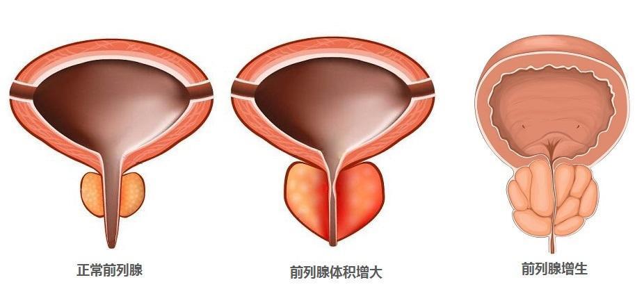 前列腺炎与前列腺增生一样吗