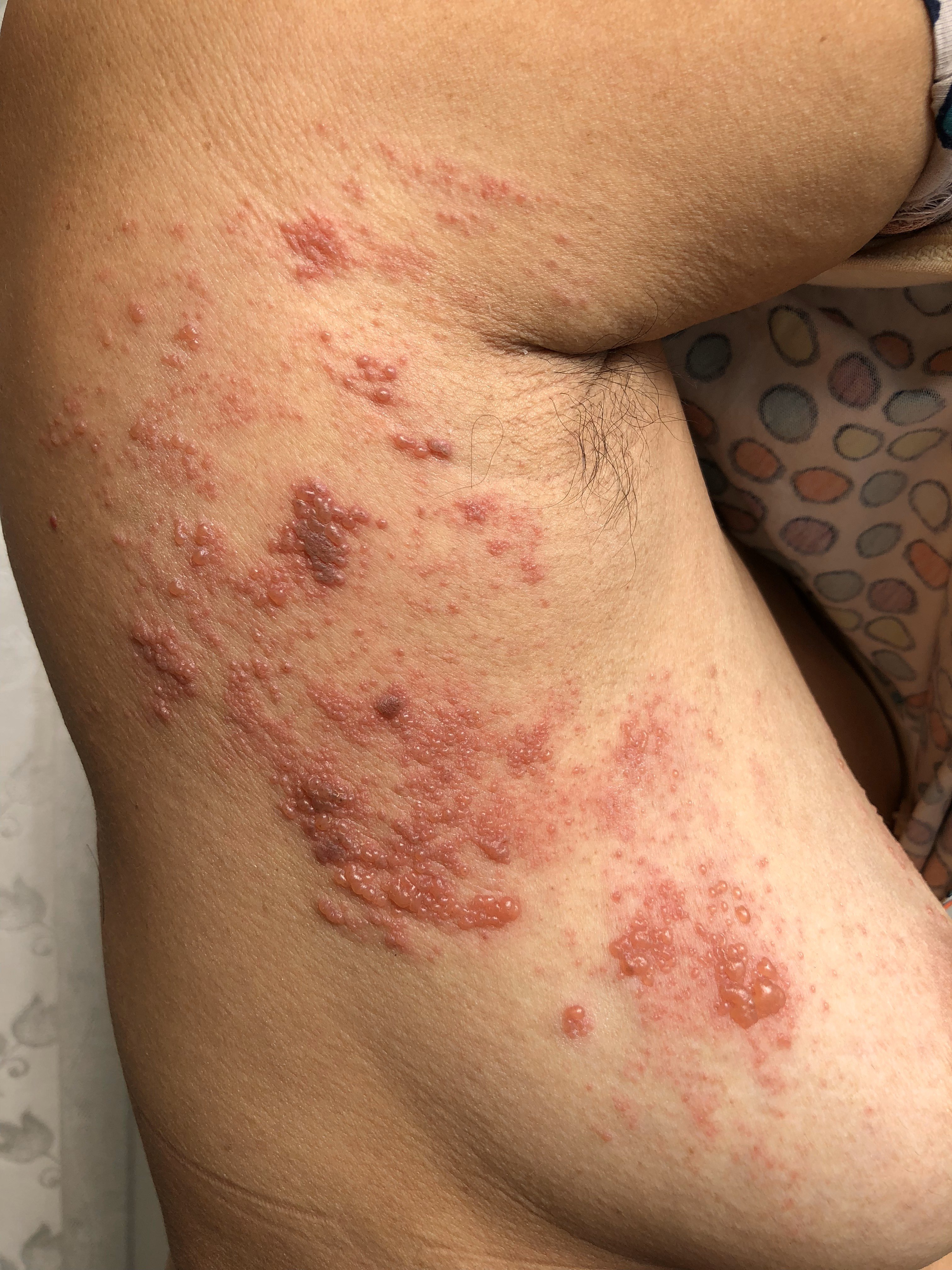 一分钟教您认识带状疱疹(