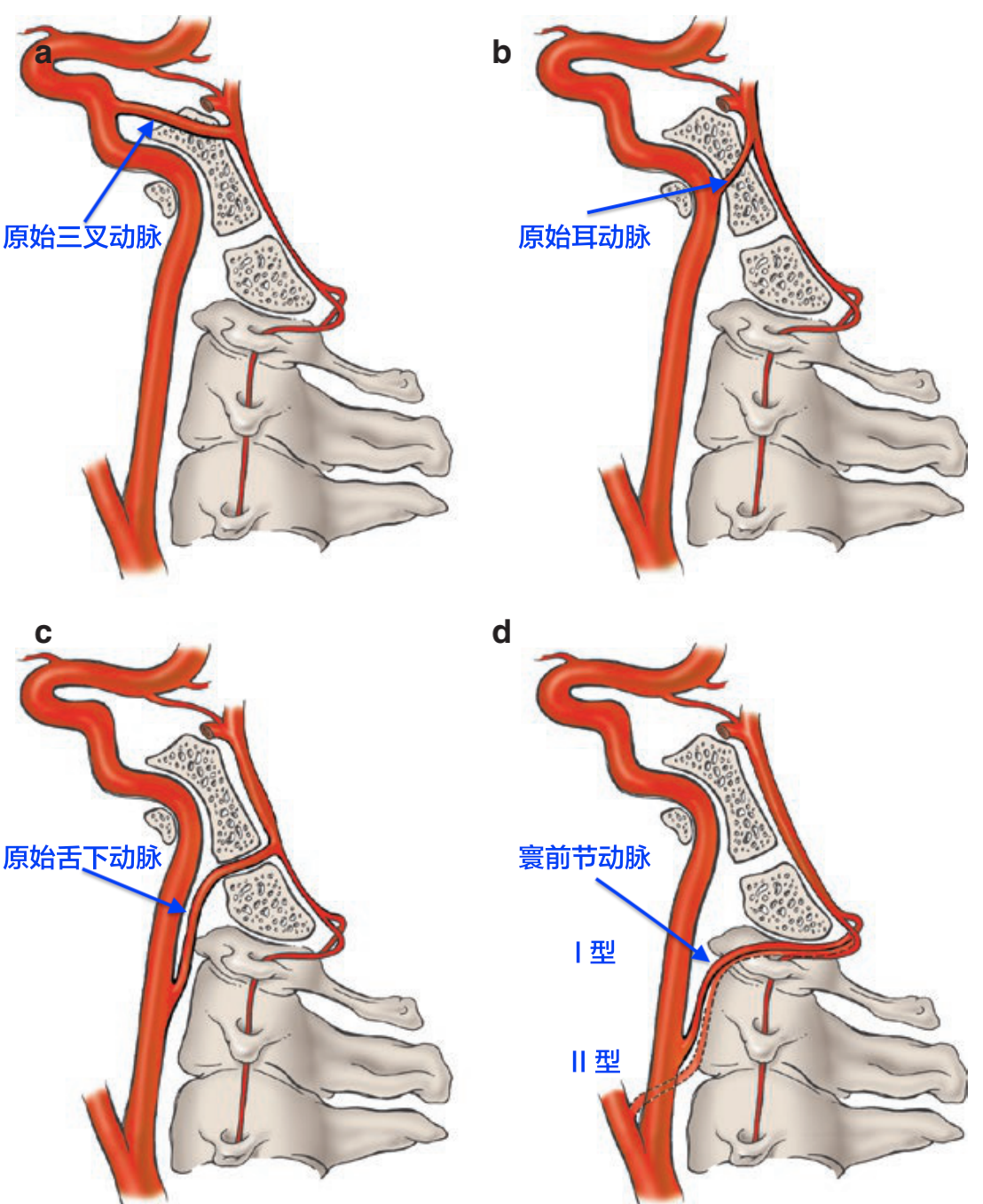 颈椎基底动脉的残留沟通.png