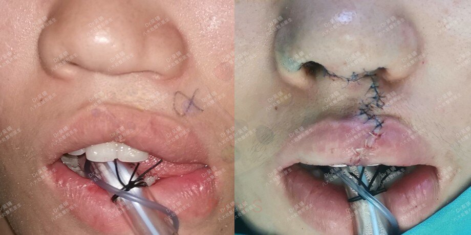 唇裂二期的唇鼻精细结构修复—唇整形(多案例分析)_唇腭裂 好