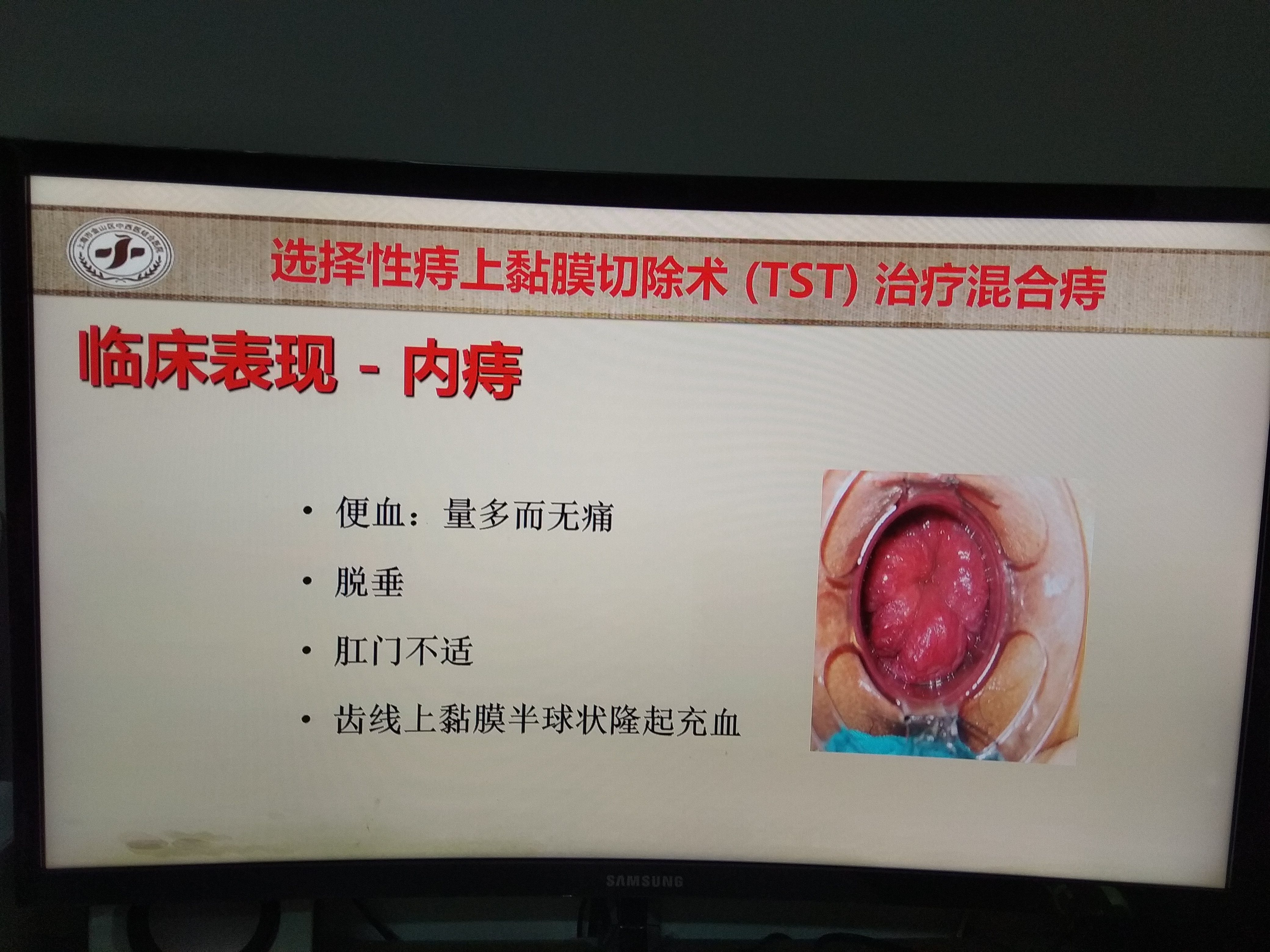 枫泾医院肛肠科特色手术方法介绍---选择性痔上黏膜