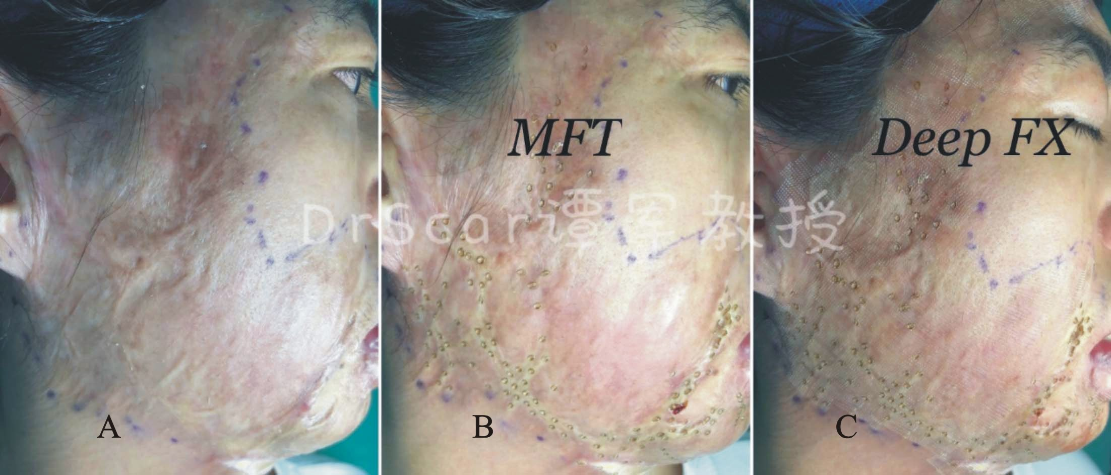 图4:右面部烧伤后增生性瘢痕