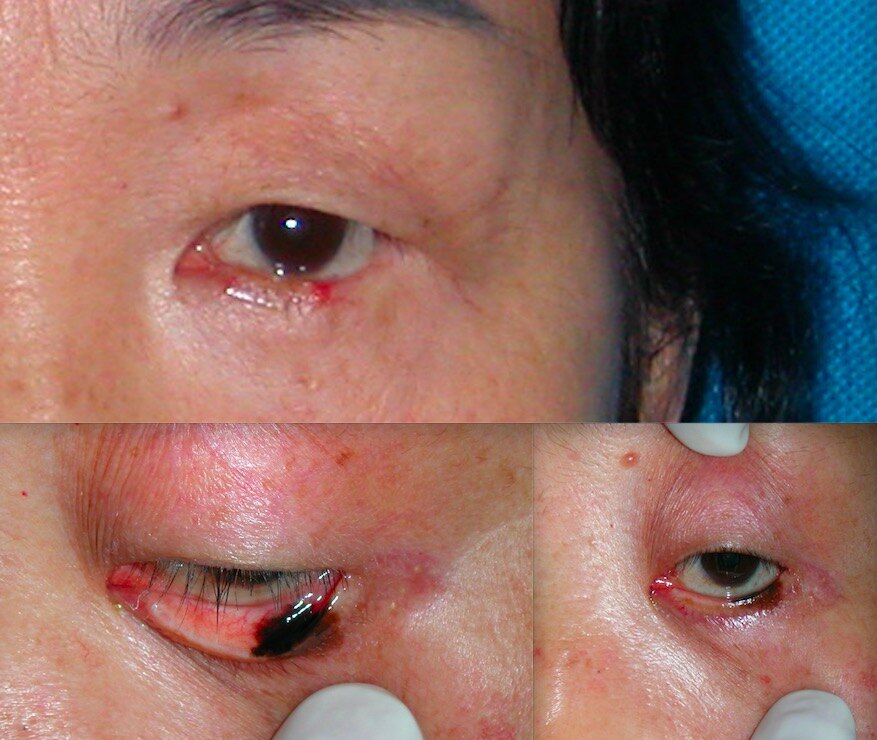 出现睑缘黑痣要注意_眼睑色素痣 - 好大夫在线