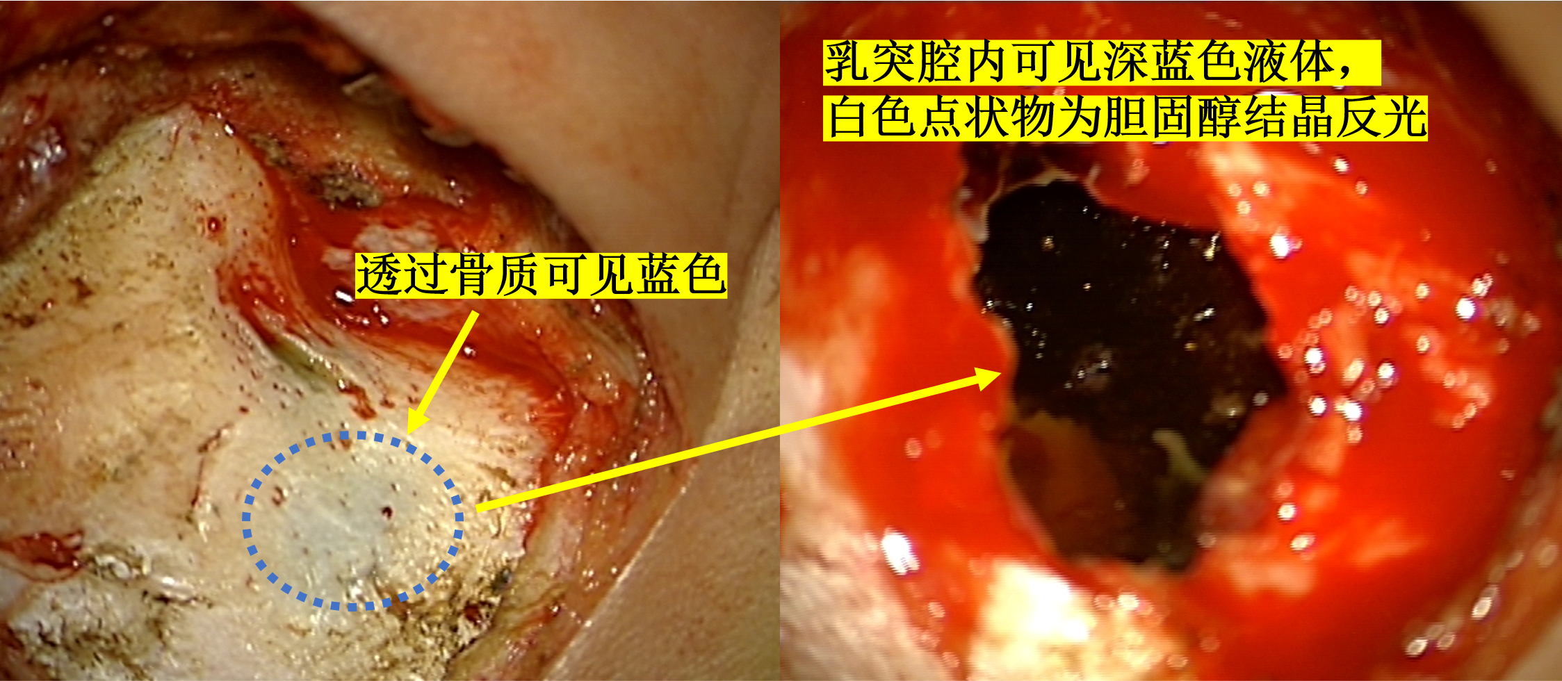 中耳胆固醇肉芽肿