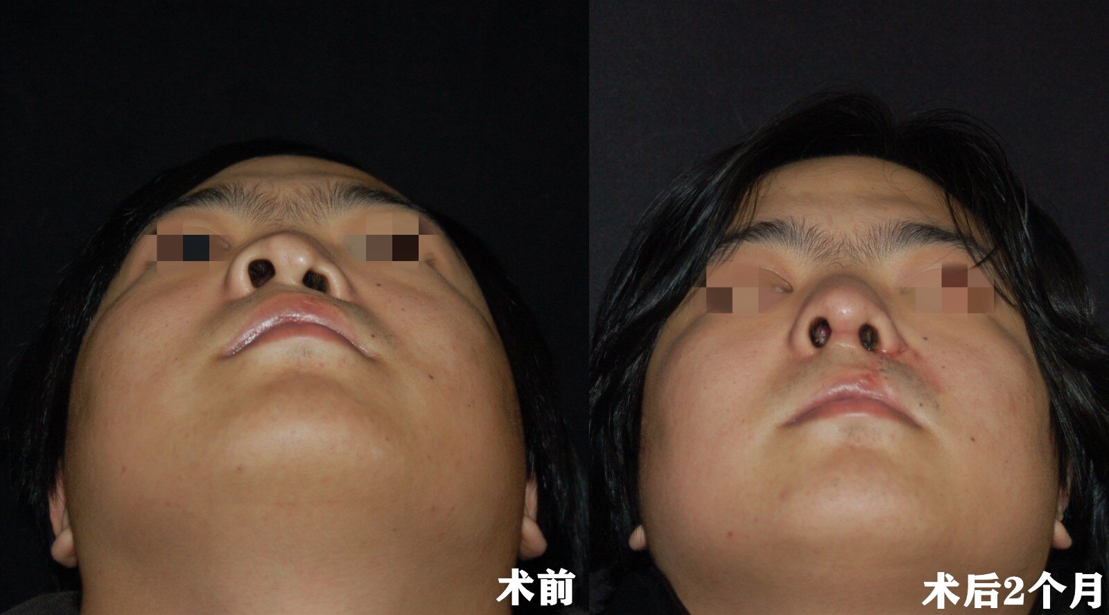随着人们对美的追求越来越高,有些 唇裂 鼻畸形患者不仅想通过手术