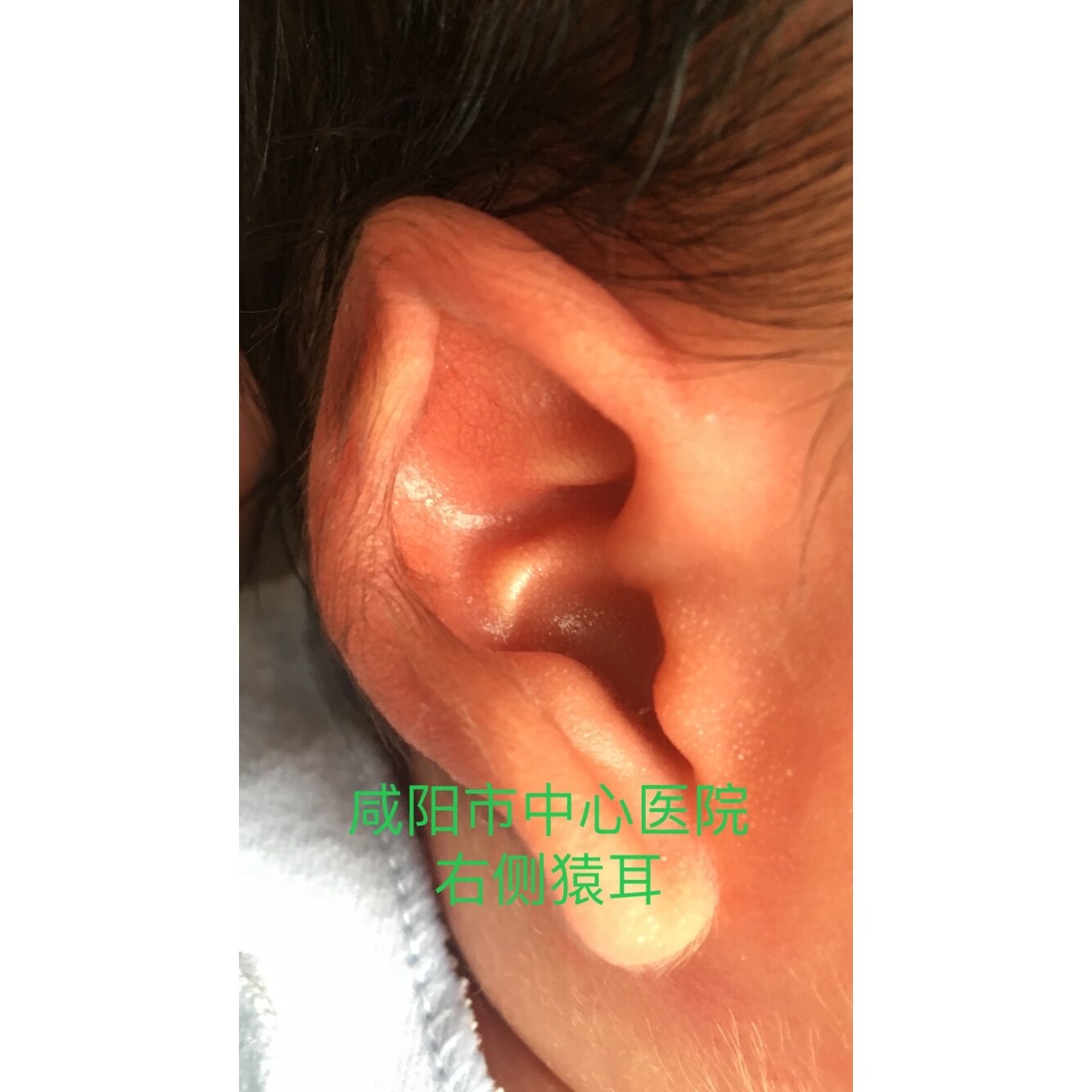 隐耳耳廓软骨上端隐入颞部头皮下,上方的颅耳沟变浅或消失,无明显的耳