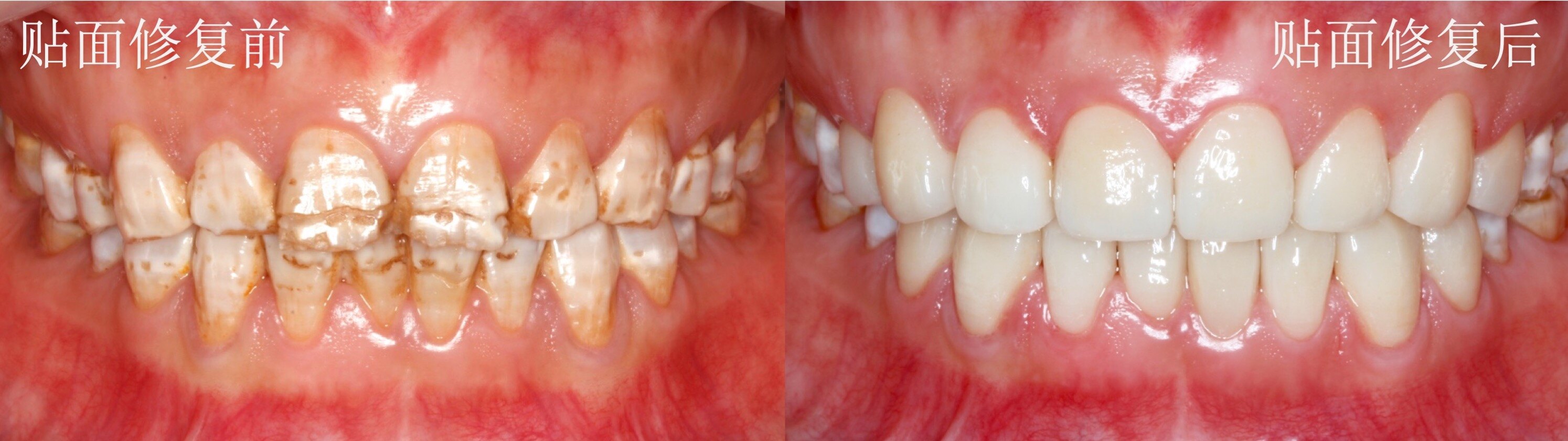 图六:重度氟斑牙全瓷贴面修复前后对比(易医生本人病例)