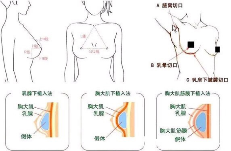 【隆胸科普】假体隆胸的并发症有哪些?