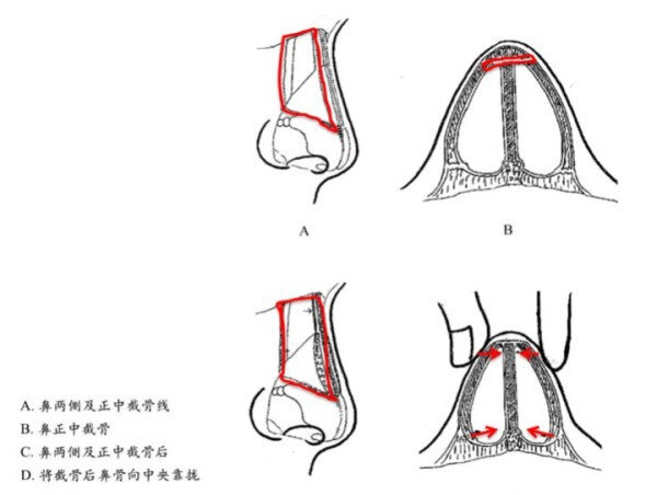 鼻骨内推是什么手术适合什么样的人做