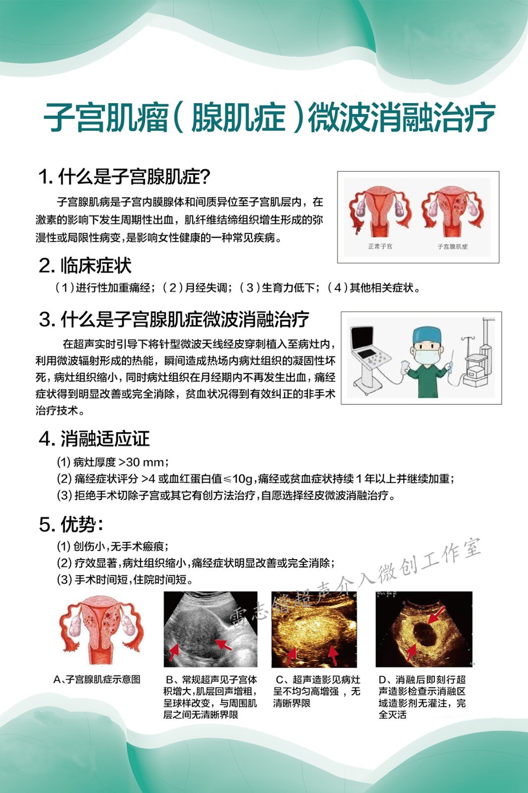 科普子宫肌瘤腺肌症微波消融治疗