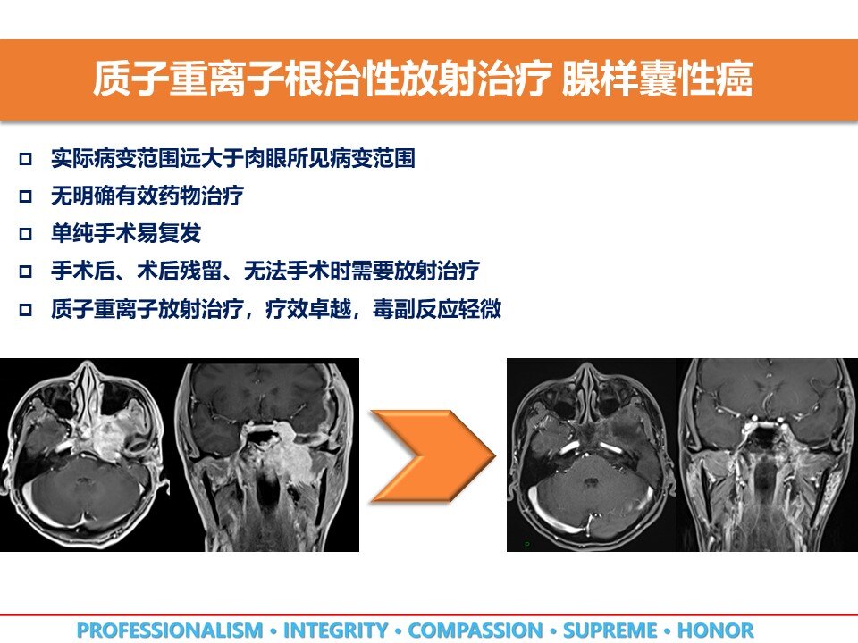 质子重离子放射治疗让头颈部腺样囊性癌不再难治