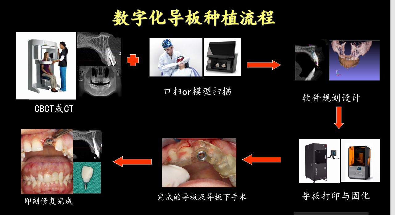 为什么要选择数字化种植牙?