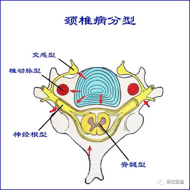 眩晕与颈椎病:鲁菲尼小体学说