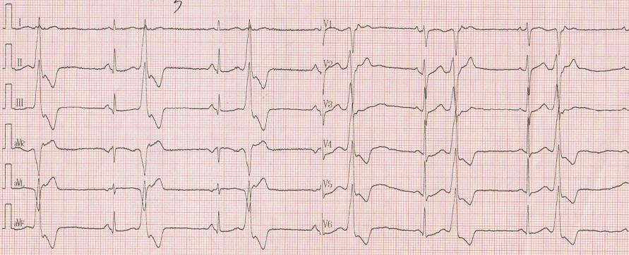 室性早搏的心电图特征为存在宽大畸形的qrs波,且宽度>0.