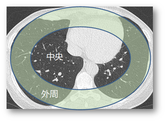 楔形切除?哪些早期肺癌可以少切肺?