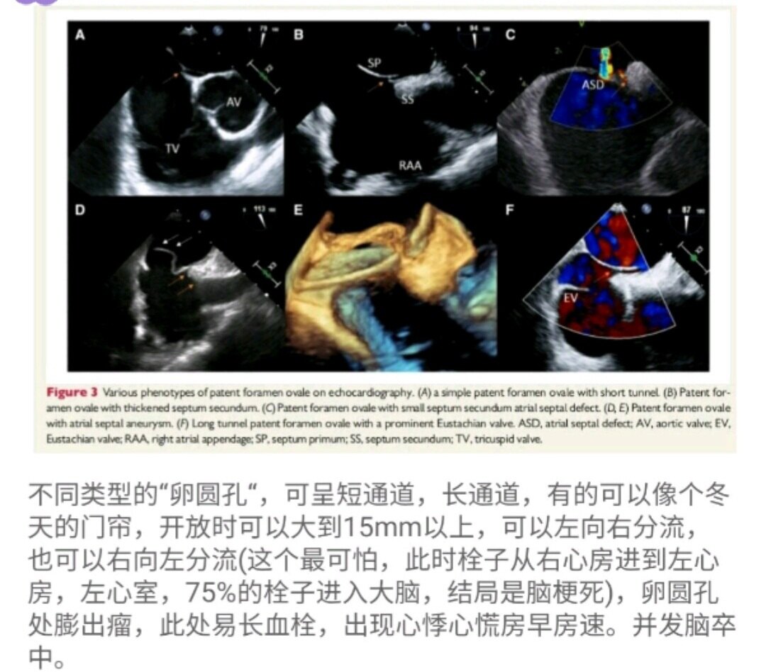 各种卵圆孔未闭形态