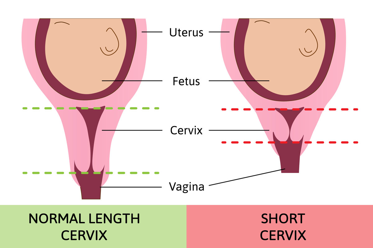 左侧为正常孕期宫颈长度,右侧为宫颈机能不全时候宫颈缩短的表显.