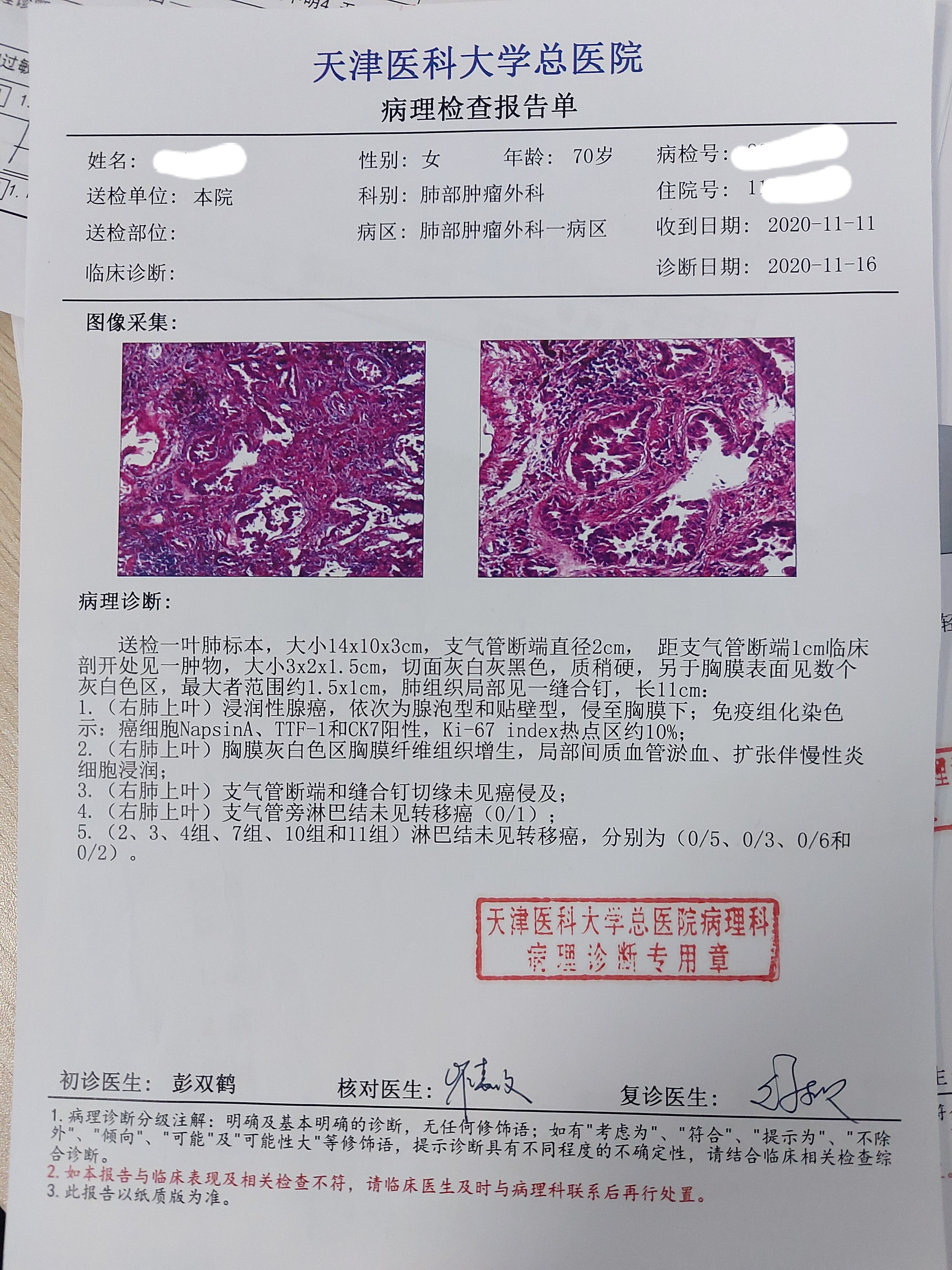 刘懿博士说肺癌(一七一一)肺癌术中肺表面有小白点是转移么?