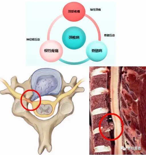 眩晕与颈椎病:鲁菲尼小体学说