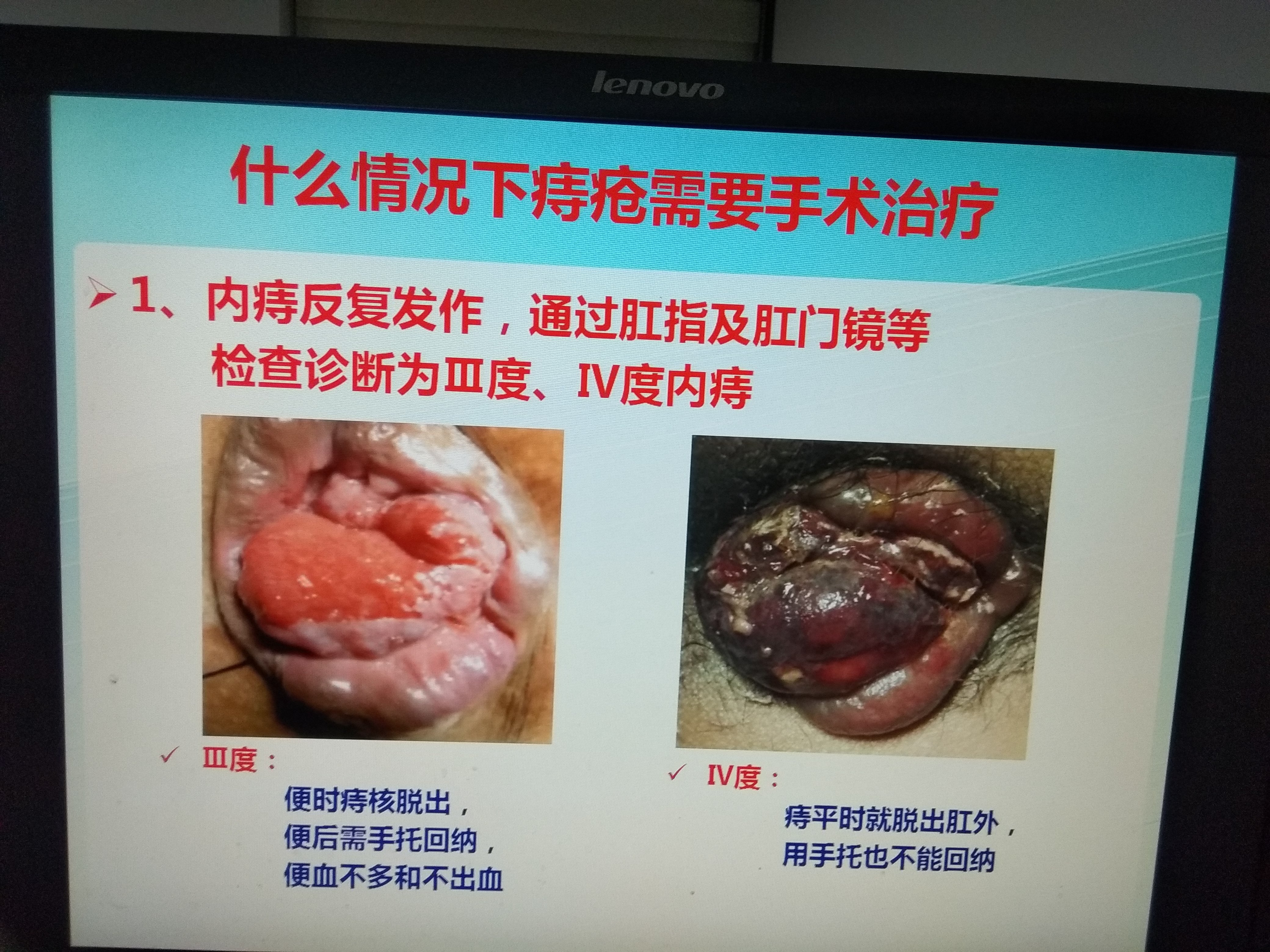 带你认识什么情况下痔疮需要手术治疗