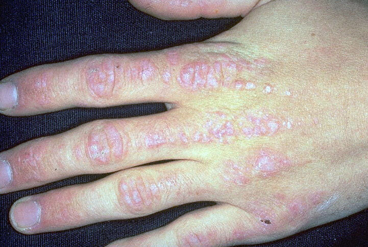 这些皮肤病需要警惕内脏恶性肿瘤—皮肤上的癌症密码之六:皮肌炎