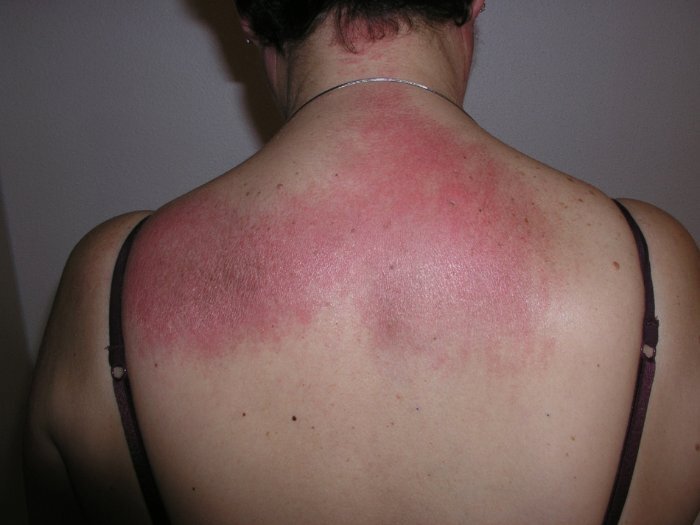 皮肌炎患者背部的红斑图5. 皮肌炎患者手背的特征性gottron丘疹