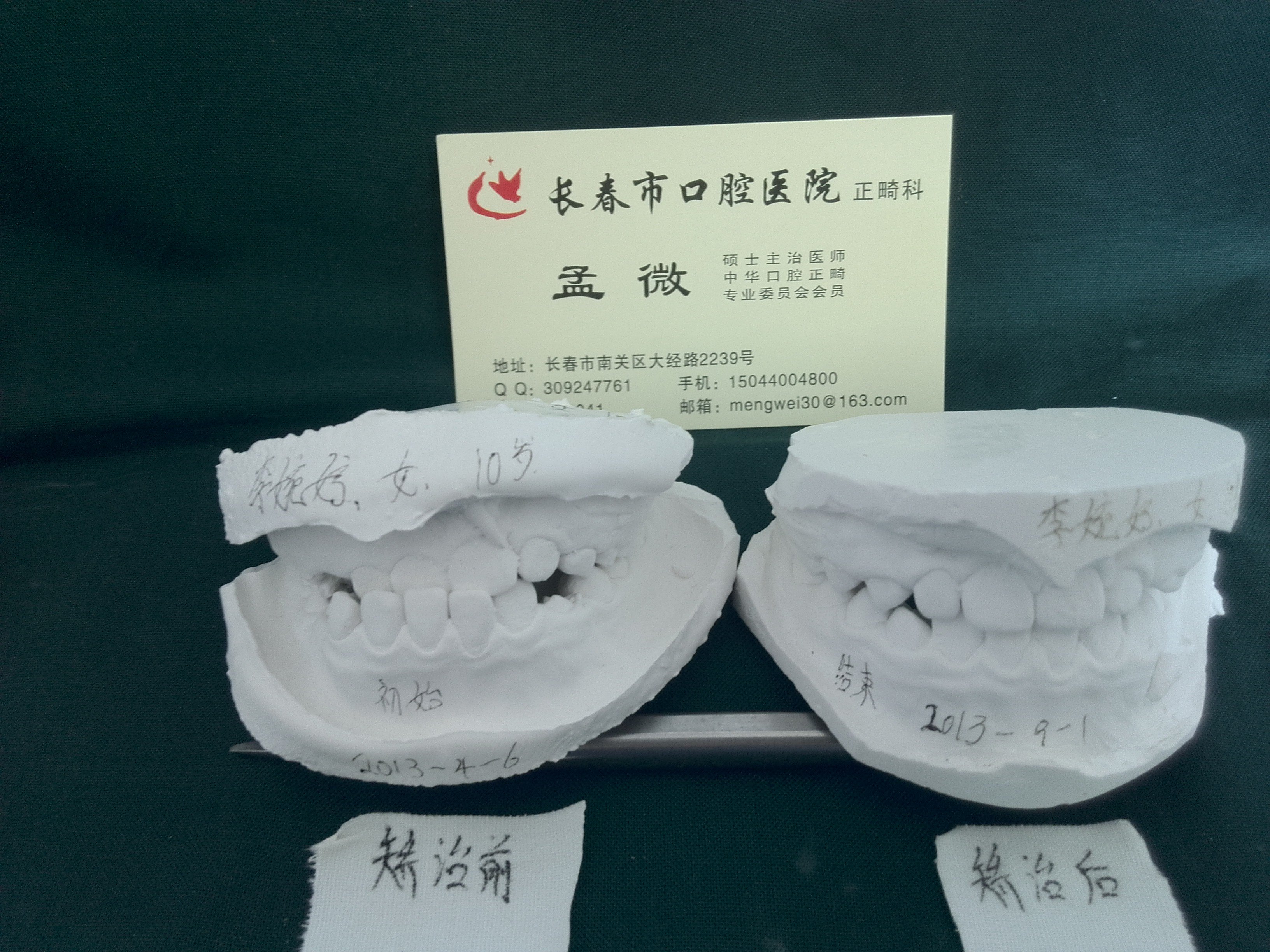 注意保护好儿童的“六龄齿”—窝沟封闭-健康教育-清华大学附属北京清华长庚医院口腔科