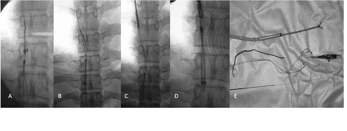 疑难性下腔静脉滤器取出的技巧及策略 - 好大夫