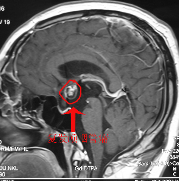 冠切右额开颅复发颅咽管瘤切除