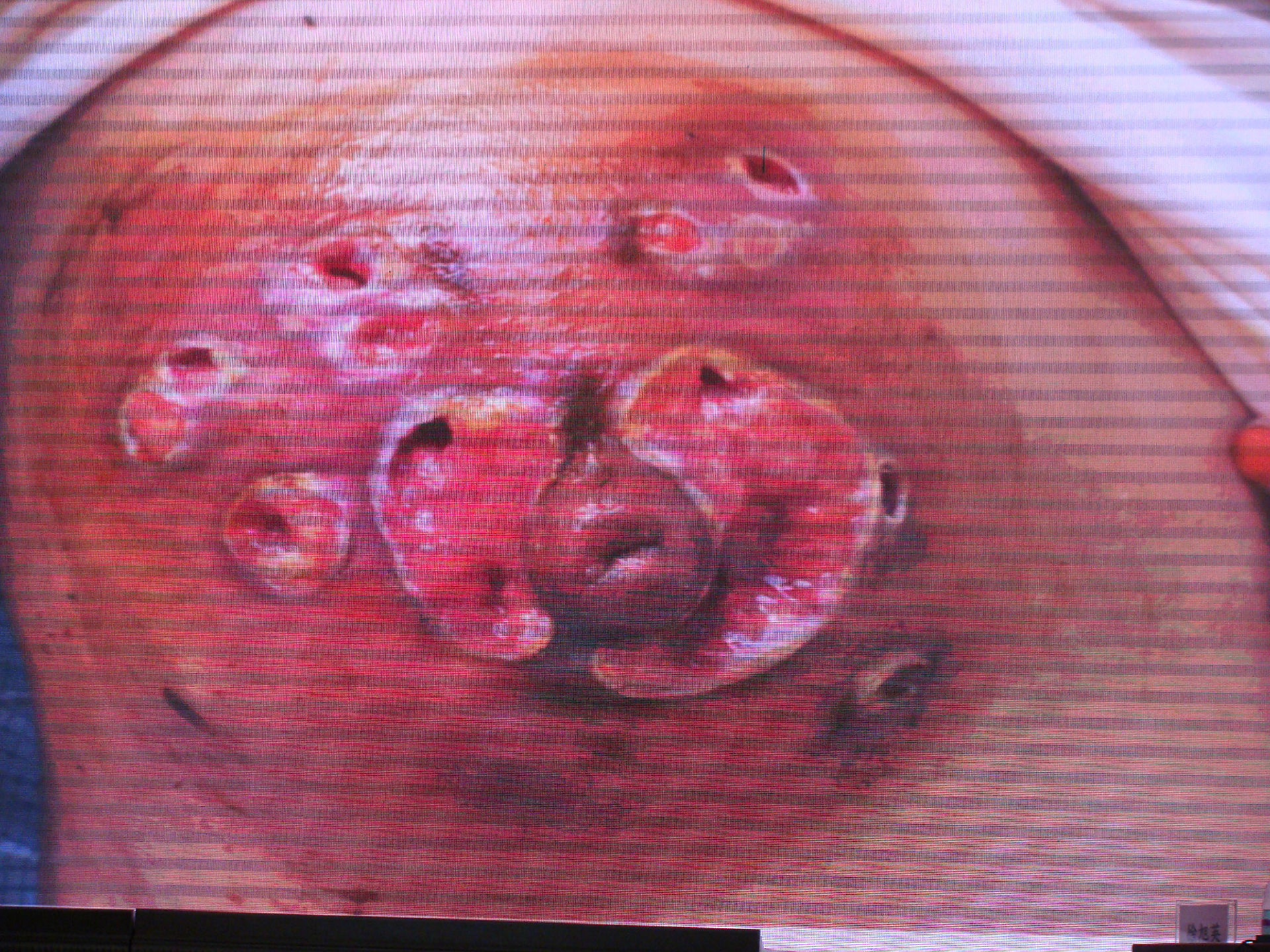 网上那些浆细胞,肉芽肿的图片是真的吗?(患者
