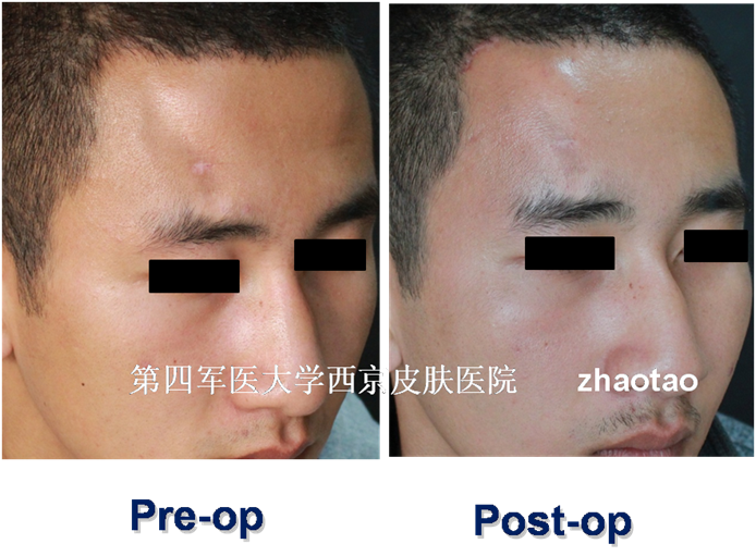 在线 赵涛 > 头面部线状硬斑病的外科治疗 线状硬斑病为局限性 硬皮病