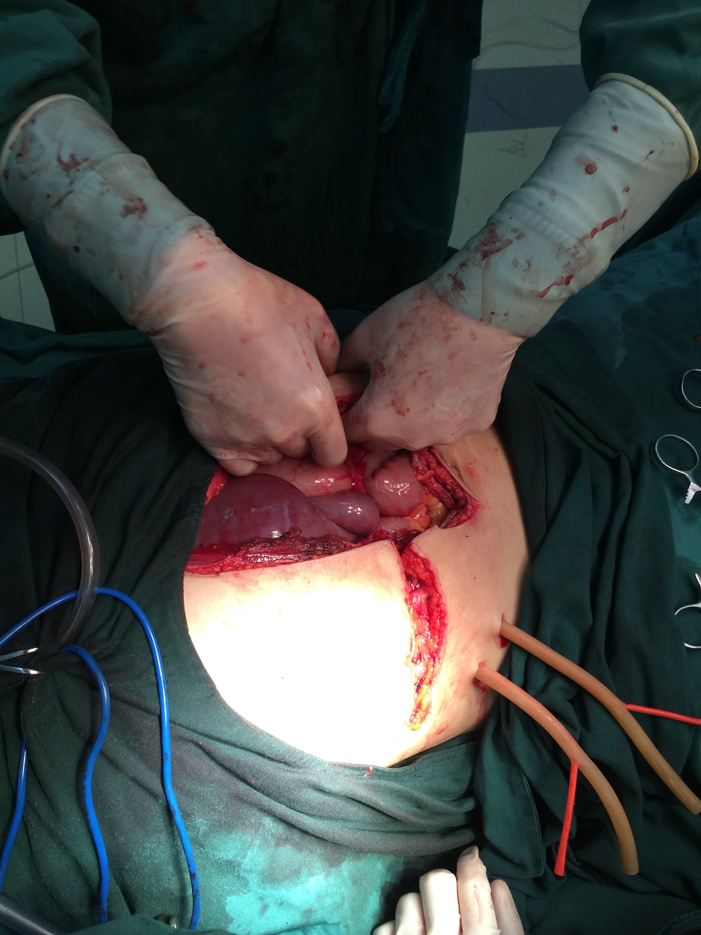 输血1万多毫升的肝静脉撕裂性肝破裂