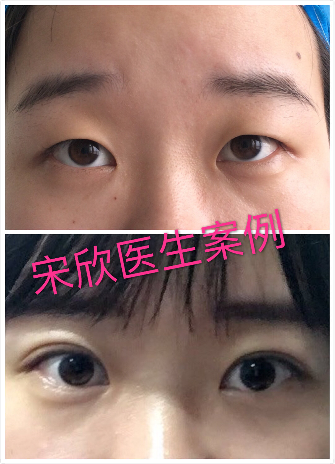 双眼皮,开眼角,上睑下垂手术前后对比-上海九院 (原创)