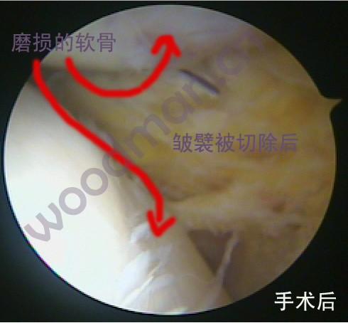 膝盖关节响、疼痛是怎么回事? 之二_膝关节损