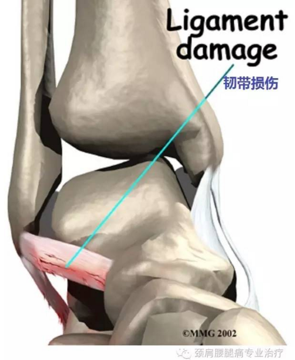 initially the ankle is swollen, painful, and may turnecchymotic